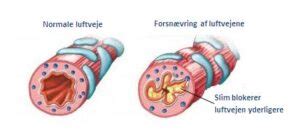 Astmatisk bronkitis hos voksne